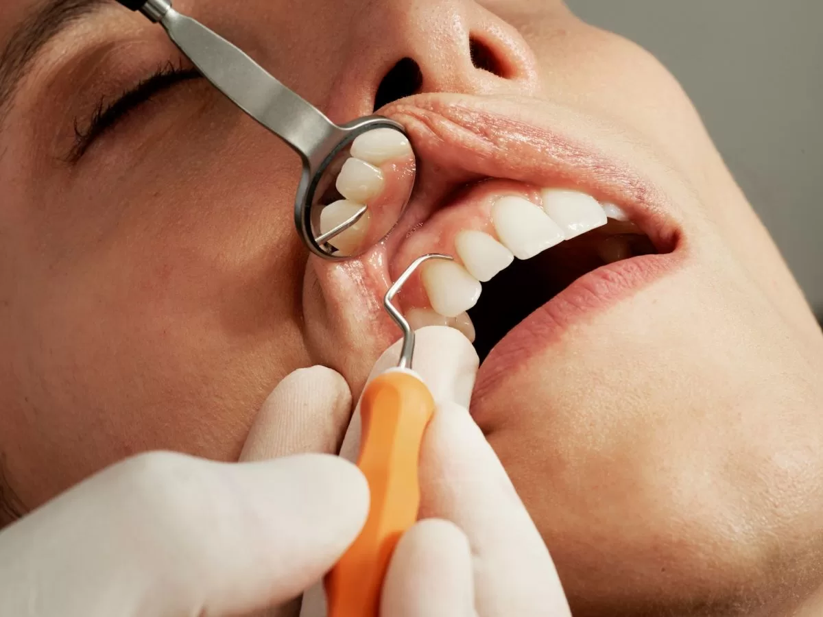 Dental Fillings Top For Effective Tooth Restoration