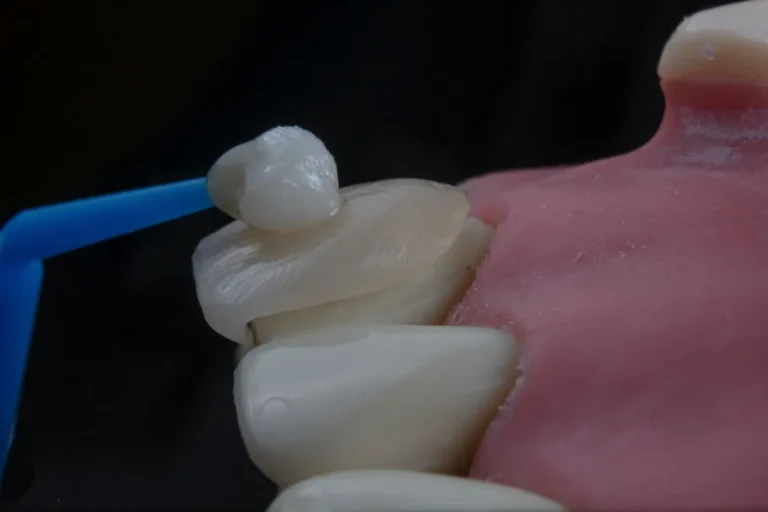 bleeding-gums-is-a-gamble-with-your-oral-health