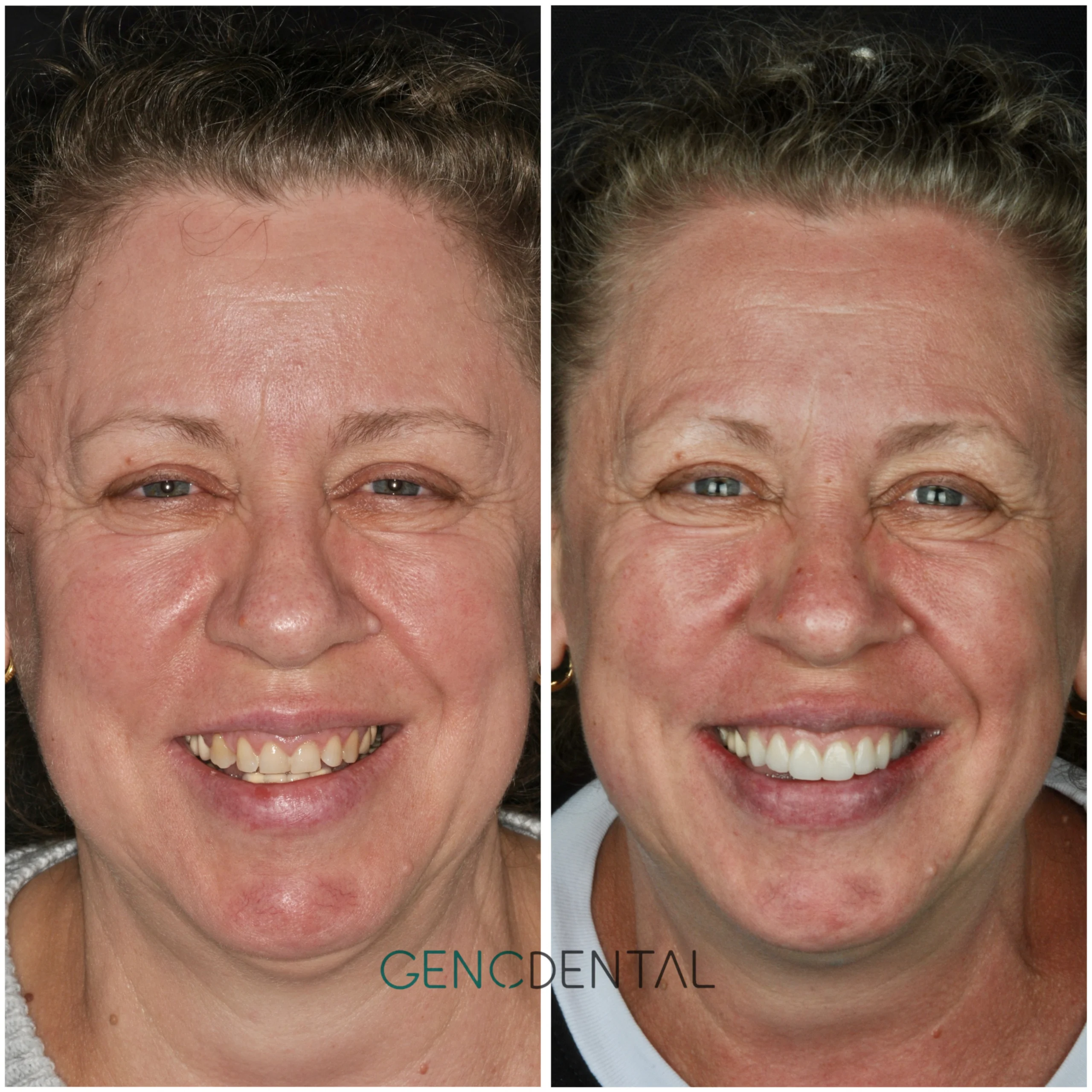 Treatment Result