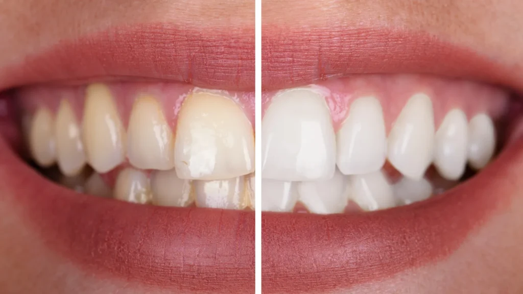  Hollywood Smile Turkey Cost 