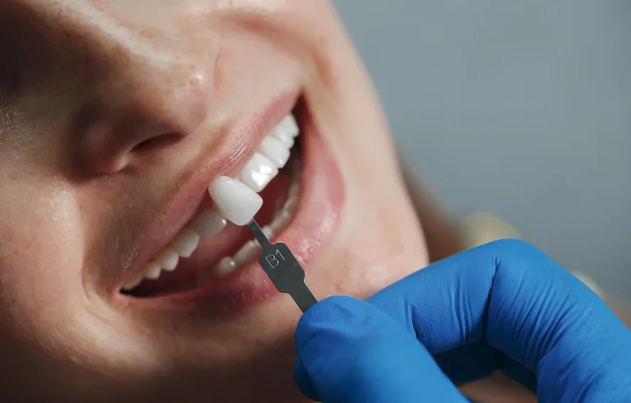 Ataşehir Diş Kaplama Çeşitleri ve Diş Kaplama Fiyatları 
