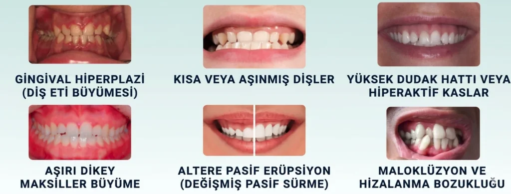 Ataşehir Diş Eti Estetiği ve Pembe Estetik Fiyatları 