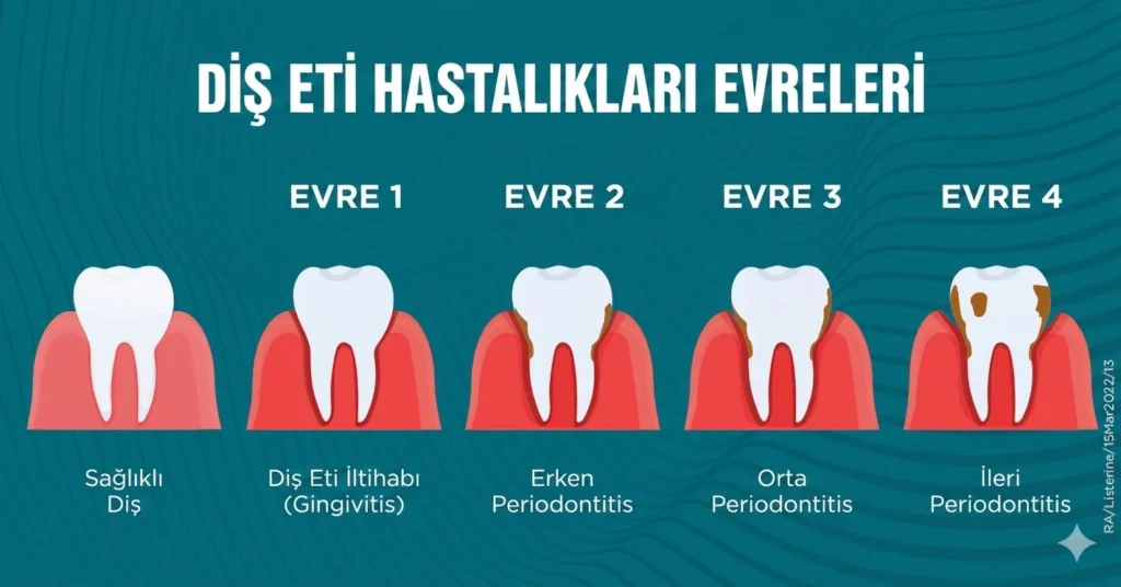 Ataşehir diş eti tedavimizde diş eti çekilmesi
