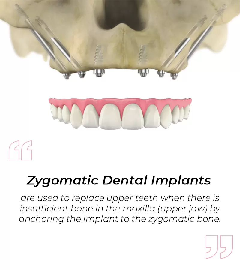 Zygomatic Dental Implants Turkey Cost 2026