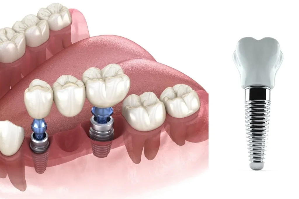 Same Day Dental Implants Turkey Cost