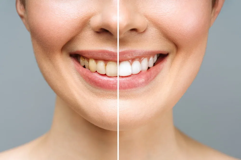 Albire dentară Turcia, rezultat obținut la Genç Dental Istanbul
