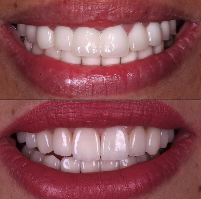 Ataşehir Emax Diş Kaplama 