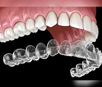 Ataşehir Invisalign Şeffaf Plak Tedavisi Fiyatları 