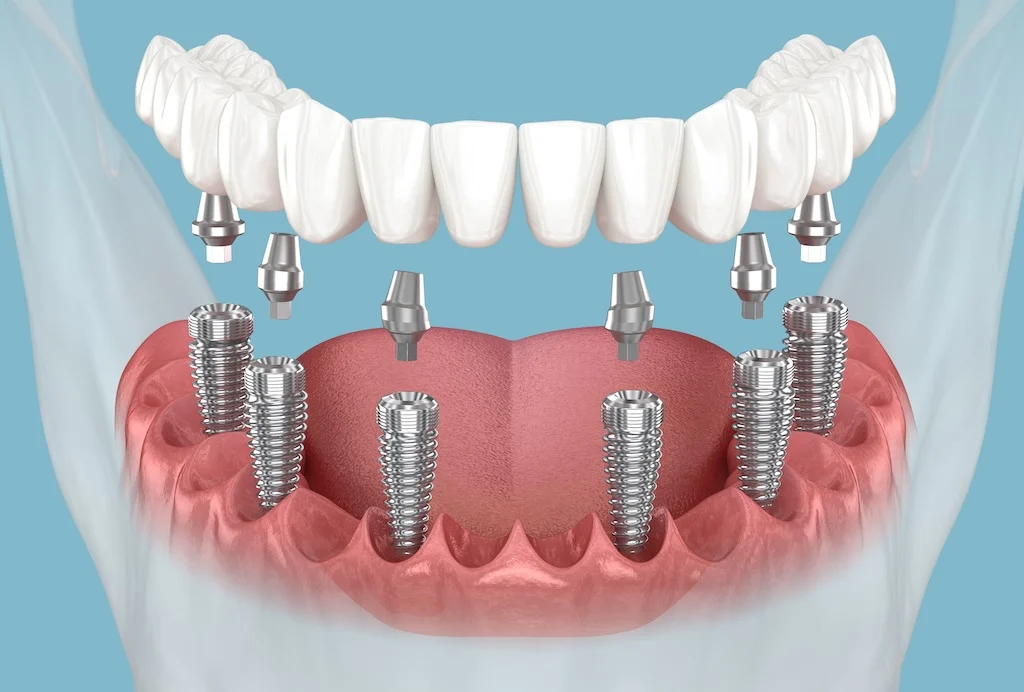 All on 6 Dental Implants Turkey Cost