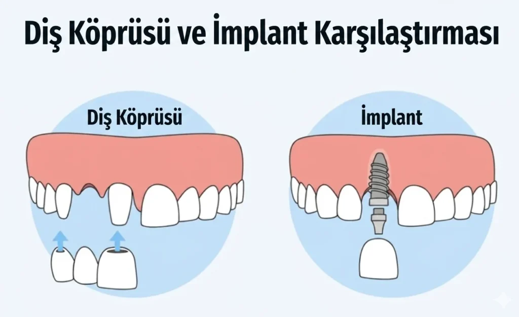 İmplant mı Köprü mü? Hangisi Daha İyi?