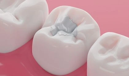 Fissür Nedir? Fissür Örtücü Ne İşe Yarar?