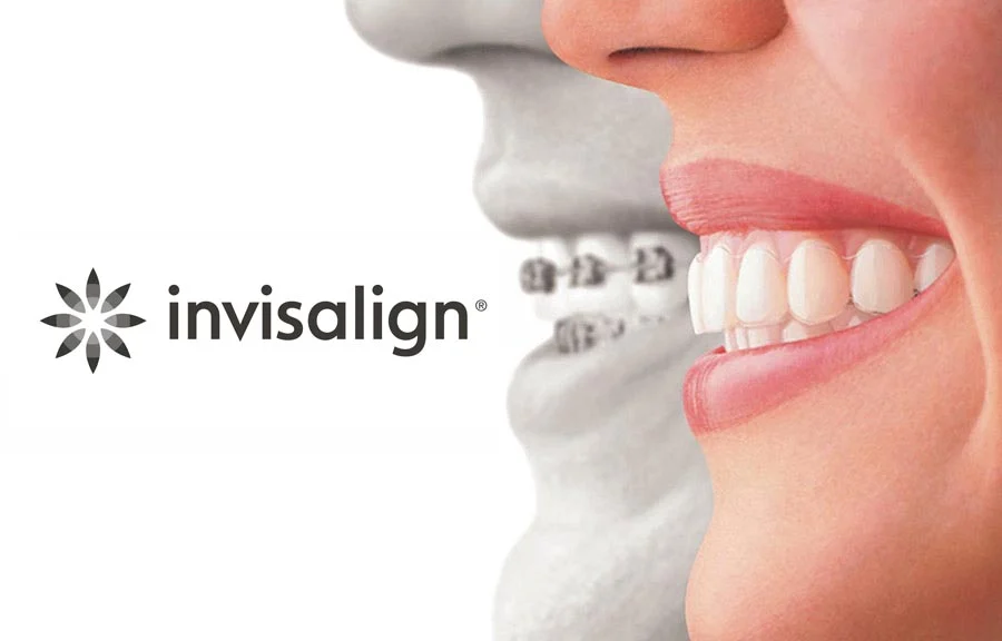 şeffaf diş teli ne işe yarar,Invisalign ve Şeffaf Plaklar Arasında Fark Var mı?