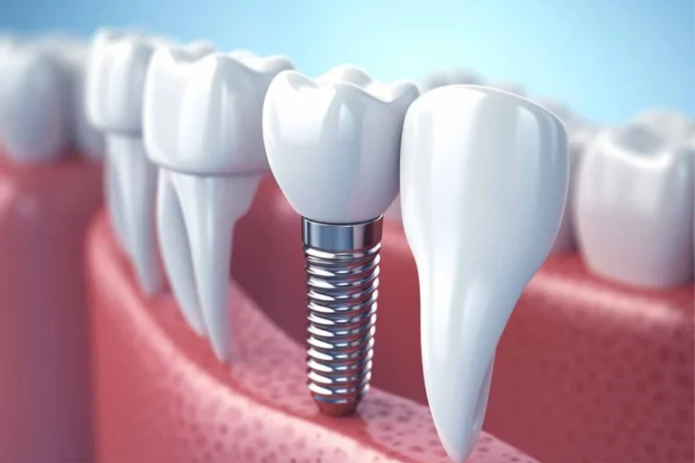 What Foods Should You Avoid After Dental Implants?