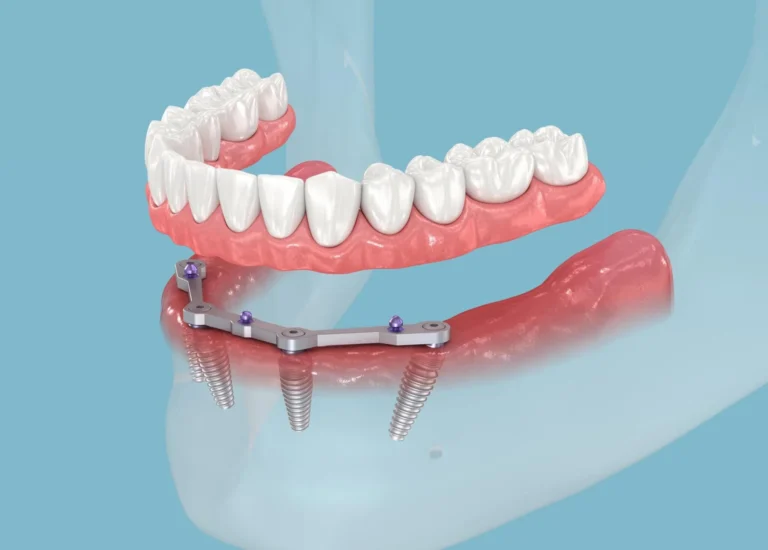How Much Do All on 4 Implants Cost in Turkey?
