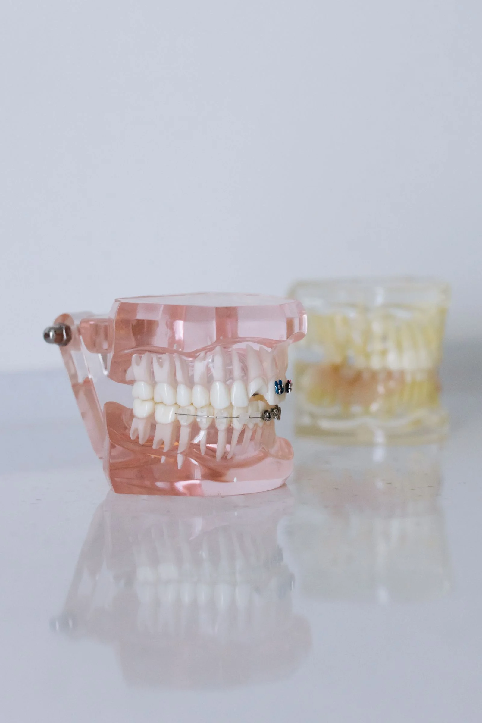 What Are Implant-Retained Dentures (Overdentures)?