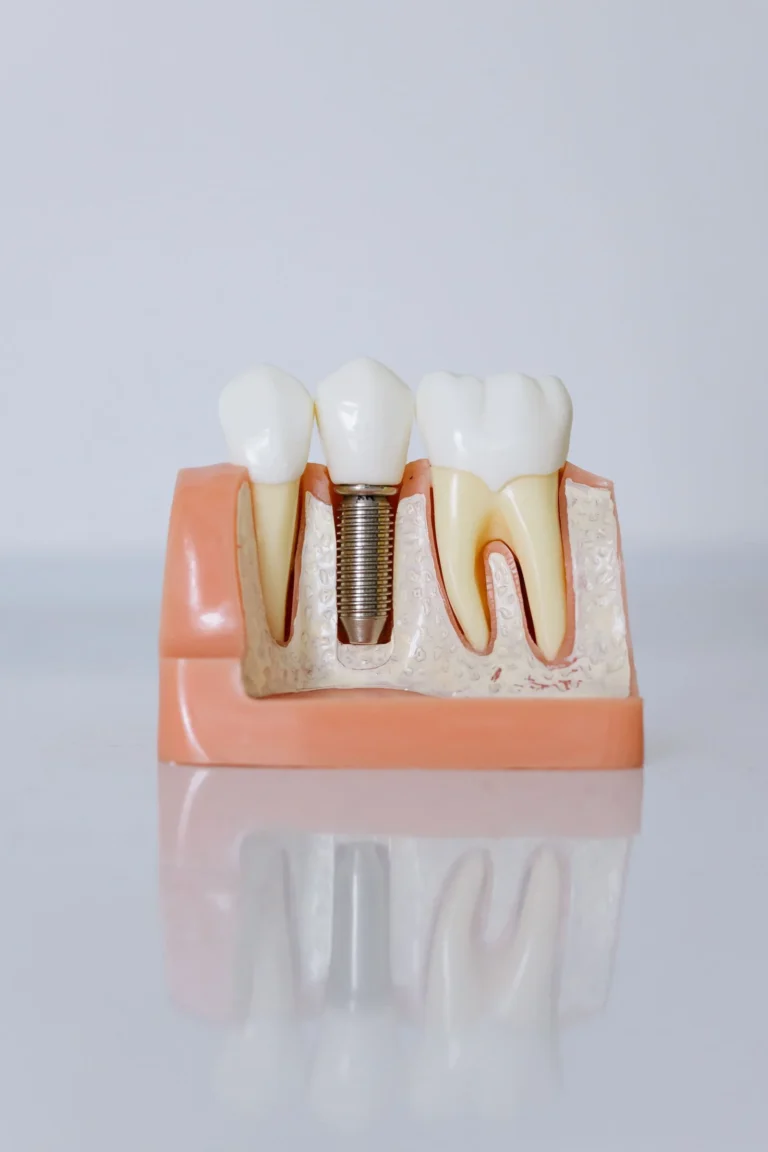All on 6 fiyatları neye göre belirlenir sorusunu gösteren implant destekli köprü modeli