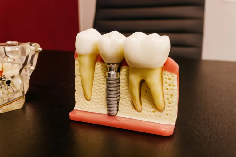 Cât costă un implant dentar în Turcia: model cu implant dentar din ceramică și șurub de titan