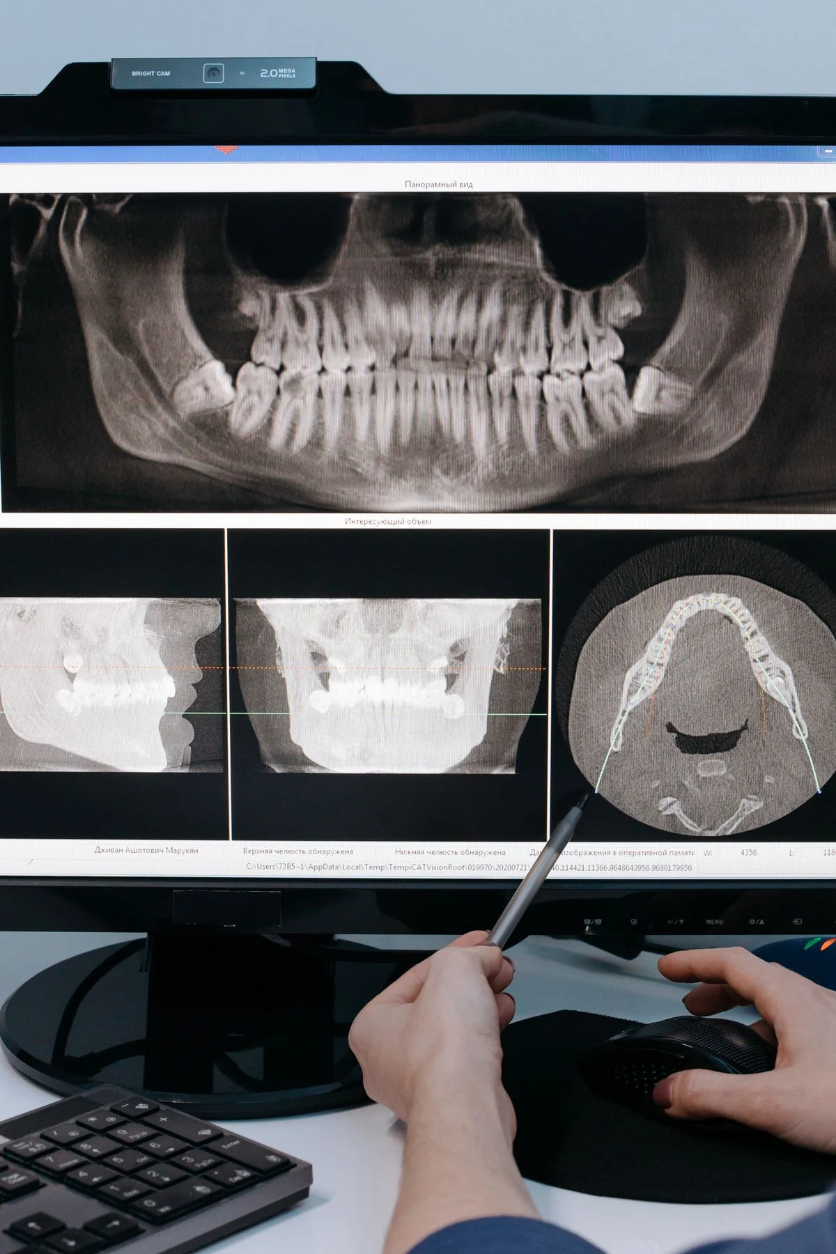 Dental professional checking bone quality on an X-ray before implant surgery