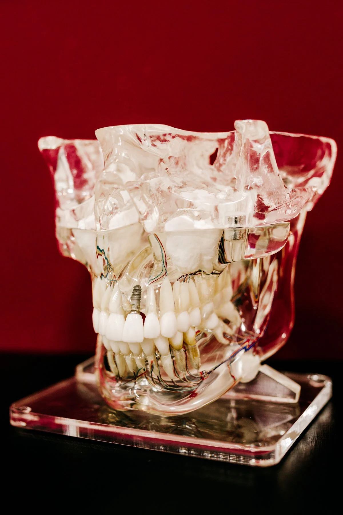 Alt ve üst çene modeli üzerinde tüm ağız implant planlaması