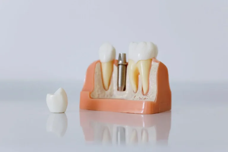 What is a dental implant abutment shown on an implant model
