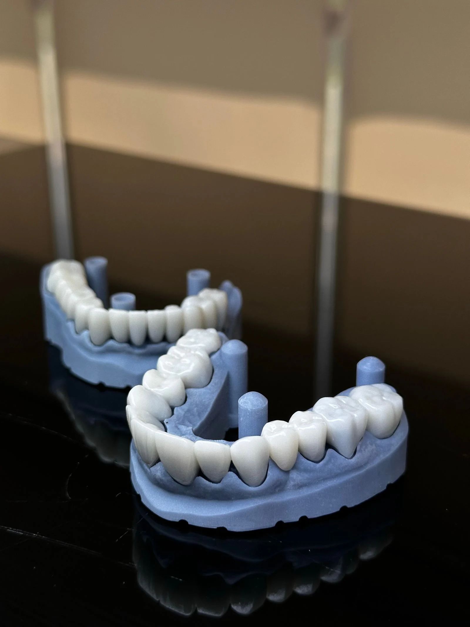 Emax veneers on a dental model showing natural translucency at the incisal edge