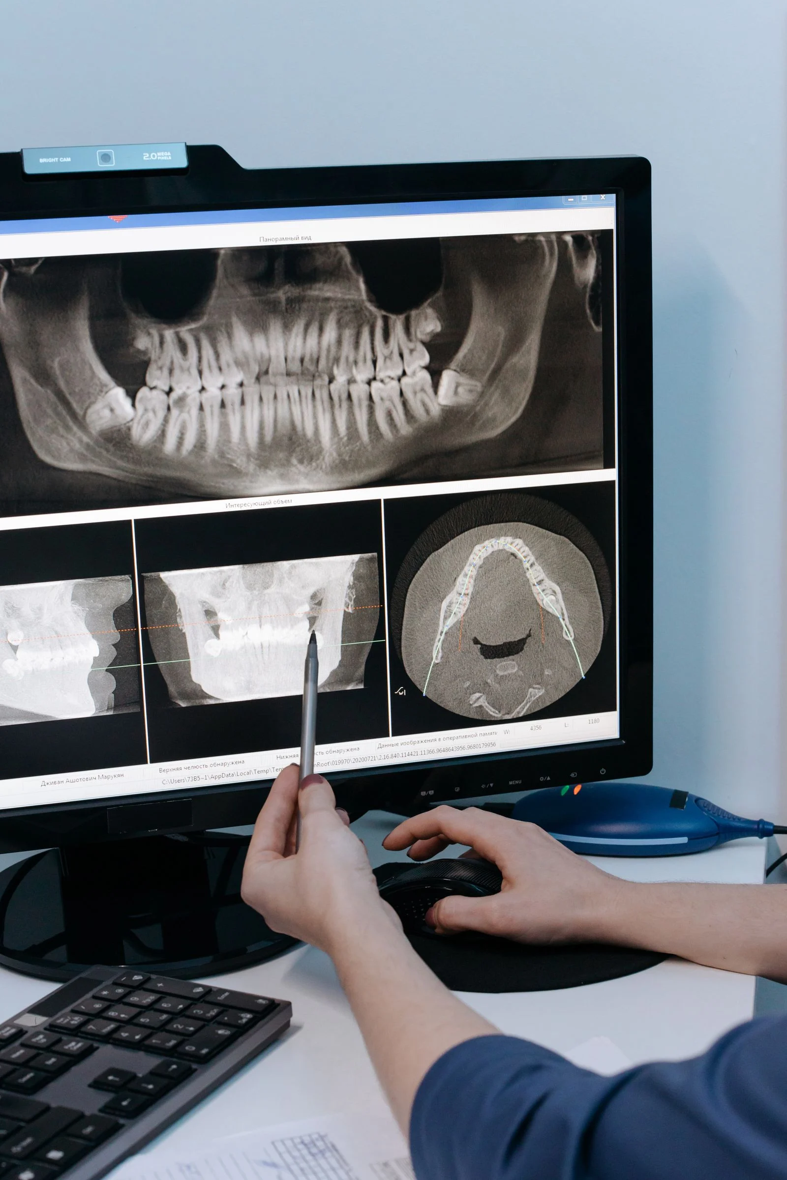What is jaw bone loss shown on a dental CT scan reviewed by an oral surgeon